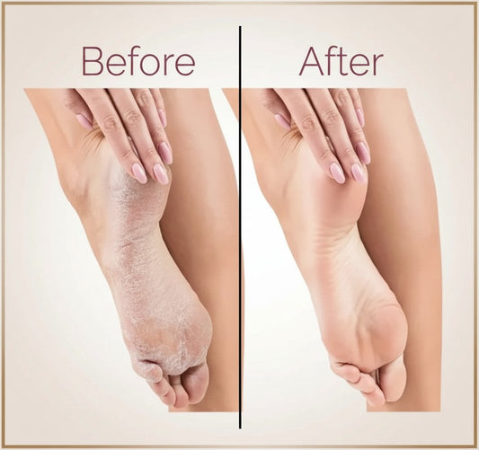 Foot Callus Remover